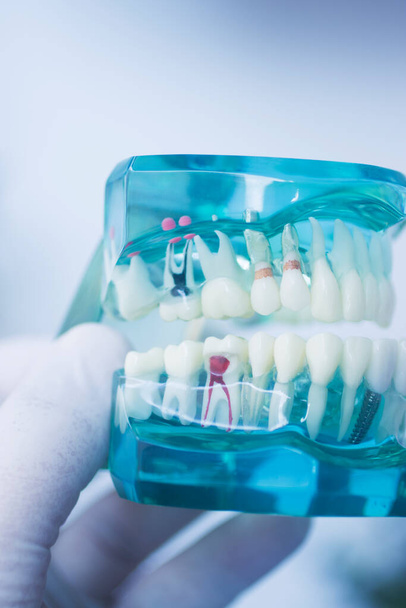 Fogszuvasodás fogászati modell mutatja fogszuvasodás - Fotó, kép