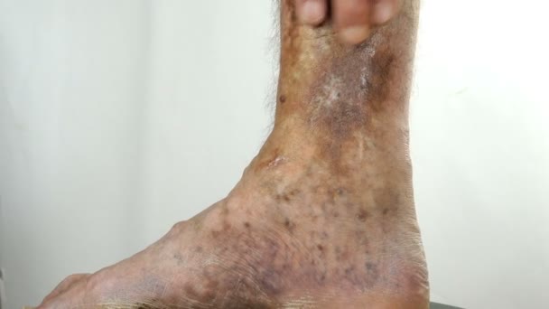Ihmisen kädet kosketa ja crumple kipeä täplikäs jalka henkilö kärsii tukos suonet, haavaumat, ihottuma, ekseema tai muita tartuntatauteja dermatologian. lähikuva. - Materiaali, video