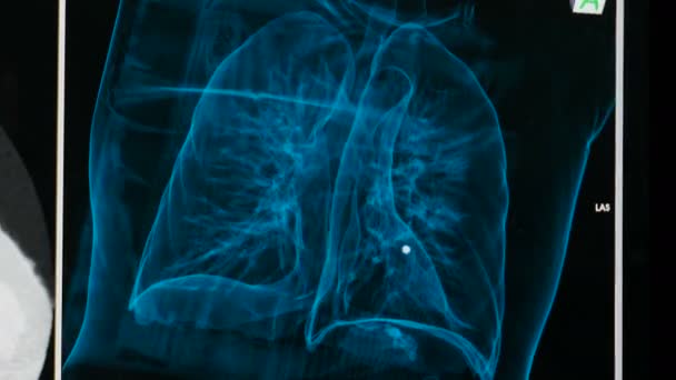 CT van longen met bevestigd geval van coronavirus Covid-19 respiratoire aandoening. X-ray Magnetic Resonance beeldvorming. CT scan animatie van de resultaten. Computertomografie van de borst. 4 k video - Video