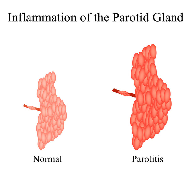 Inflamación de la glándula parótida.La estructura de la glándula salival parótida. Ilustración vectorial sobre fondo aislado - Vector, Imagen
