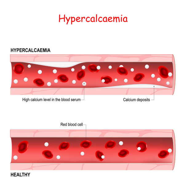 Гіперкальціємія. гіперкальціємія це високий рівень кальцію в сироватці крові. Здорові кровоносні судини та артерії з відкладами кальцію. порівняння, і відмінності
 - Вектор, зображення