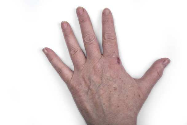 Las manos viejas femeninas con manchas y heridas - Foto, Imagen