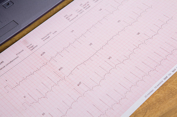Monitorowanie pulsu kardiogramu. Koncepcja zdrowia. - Zdjęcie, obraz