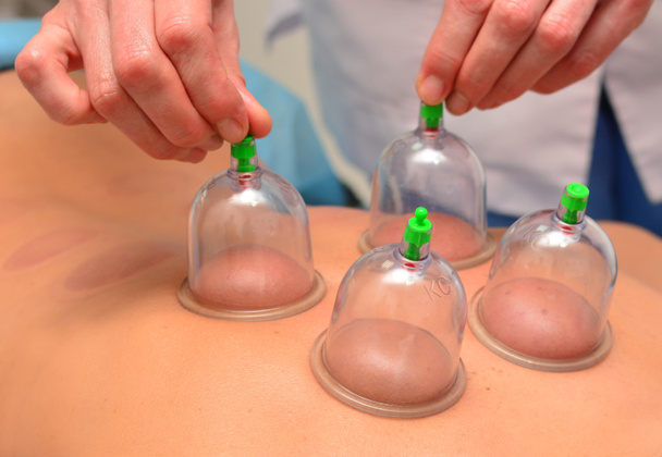 Cupping therapy, woman doctor removes cup from the patient's back - Photo, Image