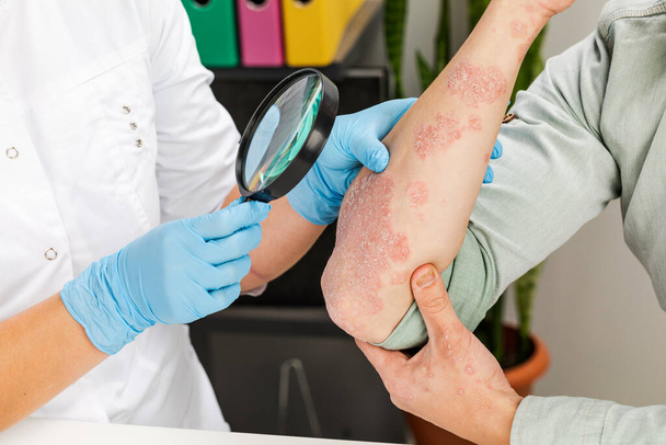 Dermatolog w rękawiczkach bada skórę chorego pacjenta. Badanie i diagnostyka chorób skóry-alergii, łuszczycy, wyprysku, zapalenia skóry. - Zdjęcie, obraz