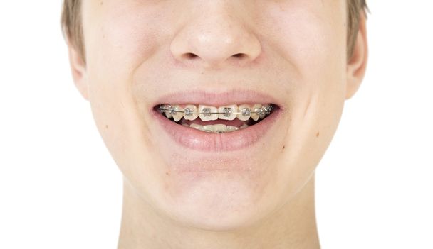 Orthodontie accolades - Foto, afbeelding