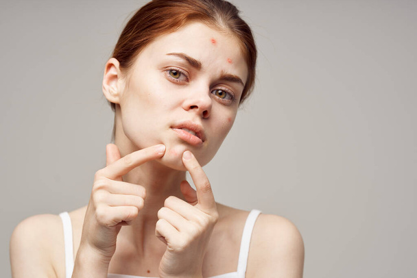 woman face skin problem acne acne portrait cropped view close-up - Photo, Image