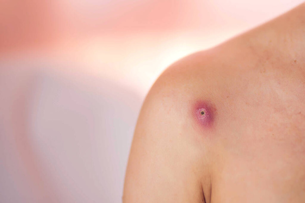 Huid van een vrouw met een dikke en pijnlijke bontoom. Mensen, geneeskunde en huidverzorging - Foto, afbeelding