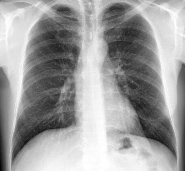 рентгенівське зображення людських грудей
 - Фото, зображення