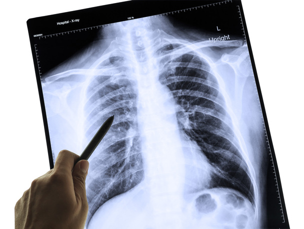 x-ray obraz człowieka klatki piersiowej dla diagnozy i ręka poin - Zdjęcie, obraz