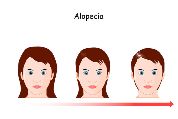 Vrouwelijke alopecia ontwikkeling. Gezondheid en schoonheid concept. Vector illustratie voor poster over gezonde levensstijl, behandeling haar de hoofdhuid, en Trichologie. diagram voor transplantatie klinieken, diagnostische centra, en PRP injecteren procedure - Vector, afbeelding