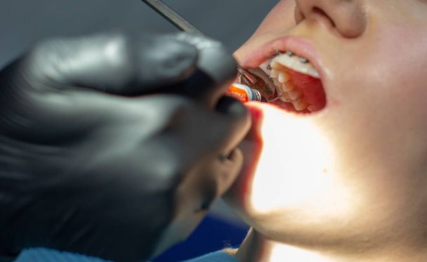 Egy nő a fogorvosnál, aki fogszabályzóra cseréli a boltíveket.. - Fotó, kép