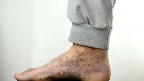Πόνος spotty πόδι του ατόμου, που πάσχουν από απόφραξη των φλεβών, έλκη, δερματίτιδα, έκζεμα. - Πλάνα, βίντεο