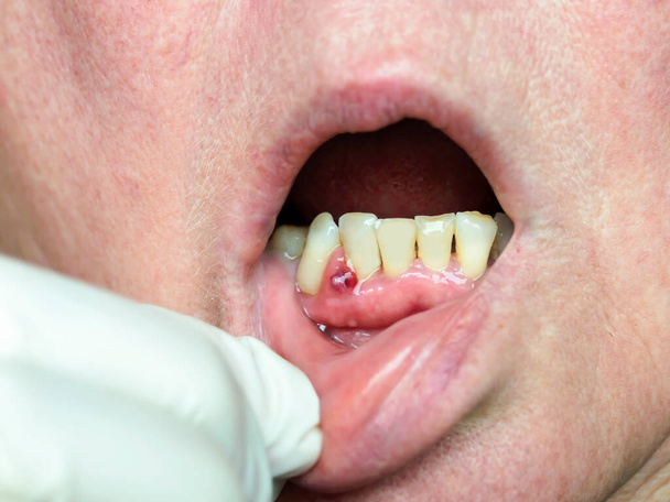 Auf dem Zahnfleisch bildete sich ein Abszess, ein Tumor mit eitrigem Inhalt. Zahnärztliche Untersuchung. - Foto, Bild