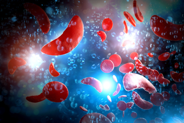 Anemia falciforme (anemia drepanocítica) células sanguíneas ilustración 3D - Foto, Imagen
