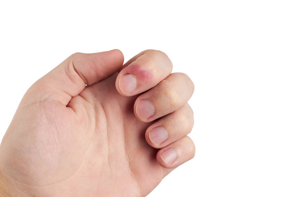 persona con enfermedad por infección en los dedos. dolor en las uñas. aislado sobre fondo blanco. espacio de copia - Foto, imagen