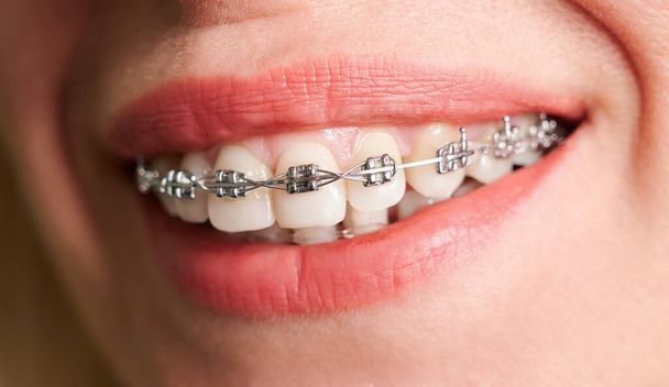 Close up de paciente do sexo feminino mostrando dentes lisos brancos com braquetes ortodônticos. Mulher demonstrando resultados do tratamento com aparelho dentário. Conceito de odontologia, atendimento odontológico e tratamento ortodôntico. - Foto, Imagem