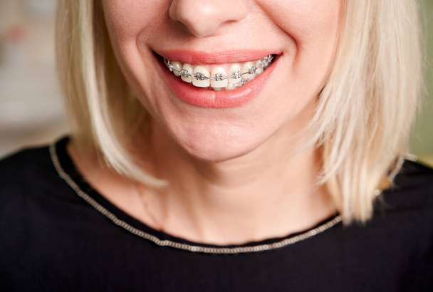 Крупный план улыбающегося пациента с белыми прямыми зубами и ортодонтическими скобками. Женщина демонстрирует результаты лечения зубных скобок. Концепция стоматологии, стоматологической помощи и ортодонтического лечения. - Фото, изображение