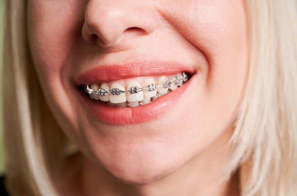 Primer plano del paciente sonriente mostrando dientes rectos blancos con soportes ortodóncicos. Mujer demostrando resultados de tratamiento de frenos dentales. Concepto de odontología, cuidado dental, tratamiento ortodóncico. - Foto, Imagen