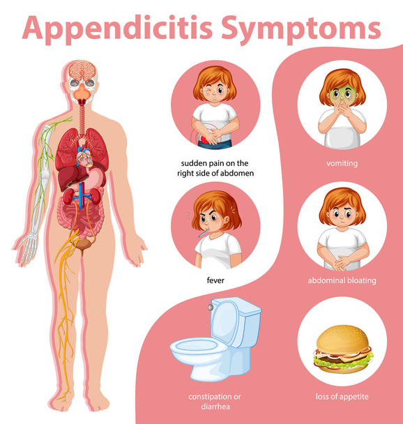 Appendicite Information sur les symptômes illustration infographique - Vecteur, image
