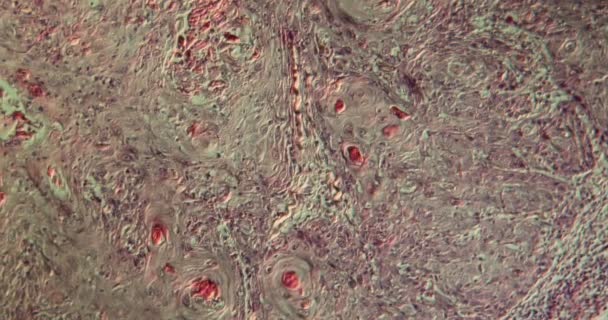 Tkanka rakowa warg pod mikroskopem 100x - Materiał filmowy, wideo
