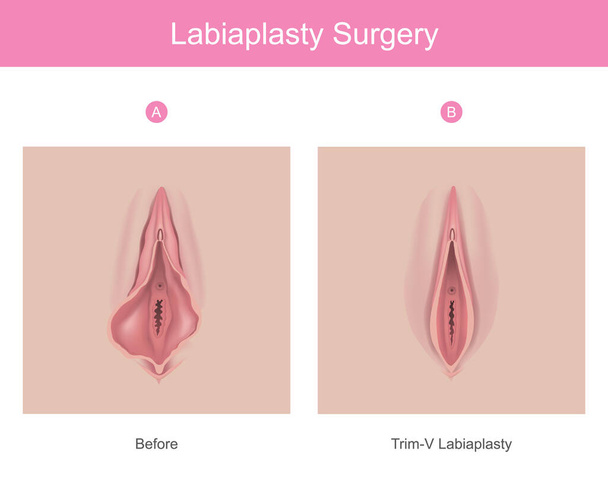 лабиапластика. Иллюстрация к медицинскому применению объясняет процедуру хирургического вмешательства для уменьшения размеров внутренних тканей женских половых органов - Вектор,изображение