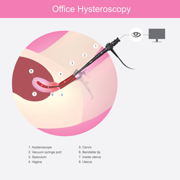 Office Hysteroscopy. Illustration showing the doctors use a micro camera (hysteroscope) insert passed a vagina into the uterus for diagnosis symptom - Vektor, obrázek