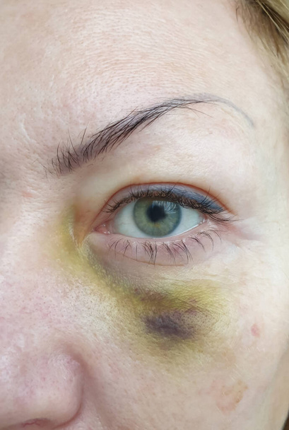 女性の目の負傷がクローズアップされ - 写真・画像