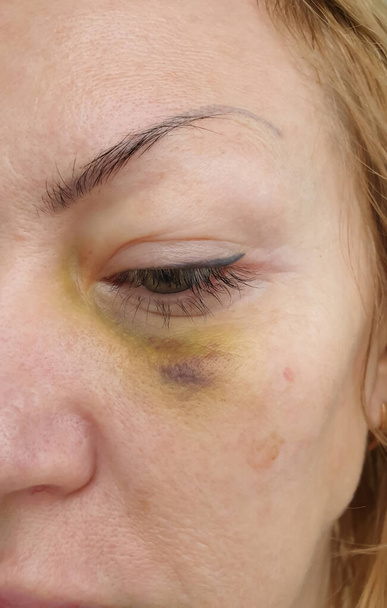 femme blessure aux yeux gros plan - Photo, image