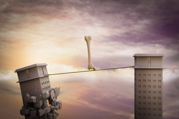 Человеческая бедренная кость на веревке с одним небоскребом, готовым рухнуть. Концепция остеопороза. 3D иллюстрация - Фото, изображение