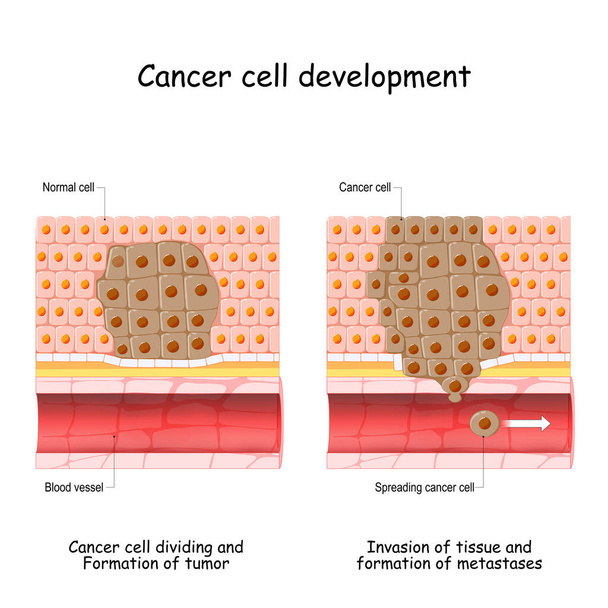 développement du cancer de la cellule normale à la formation de tumeurs, la propagation des cellules cancéreuses dans le flux sanguin, l'invasion d'autres tissus, et la formation de métastases. illustration vectorielle - Vecteur, image