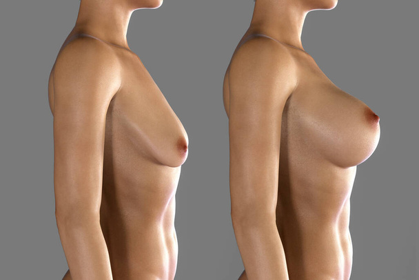 Female breast augmentation with uplift surgery, 3D illustration showing breast before and after surgery - Fotoğraf, Görsel