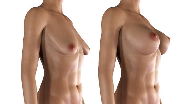 Göğüs büyütme ameliyatlı bir kadın. Ameliyattan önce ve sonra göğüslerini gösteren üç boyutlu bir illüstrasyon. - Fotoğraf, Görsel