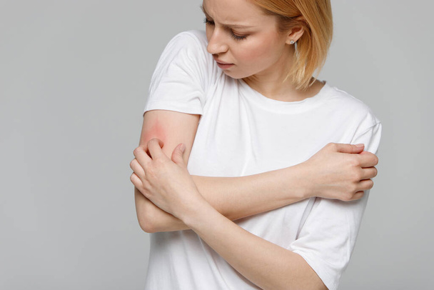 Close up of young woman scratching the itch on her hand, isolated on grey background. Dry skin, animal/food allergy, dermatitis, insect bites, irritation concept.  - Photo, Image