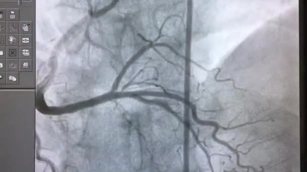 Coronary angiography , right coronary angiography - Footage, Video