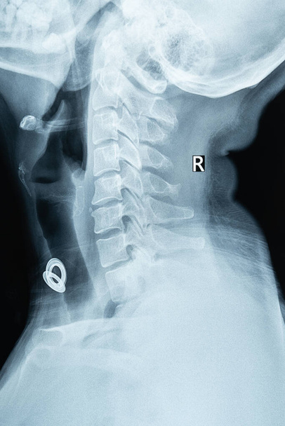 Pellicola a raggi XX prelevata dalla colonna vertebrale cervicale per un esame medico in ospedale  - Foto, immagini