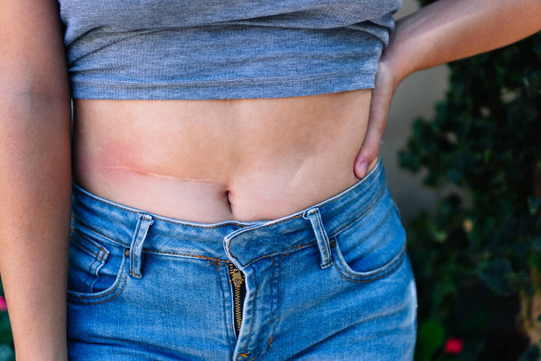 Una donna che mostra una cicatrice sull'addome che è diventata grassa dopo la nascita del bambino - Foto, immagini