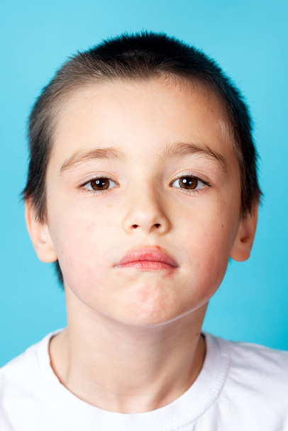 Porträt eines traurigen Jungen mit leichter perioraler Dermatitis auf blauem Hintergrund - Foto, Bild