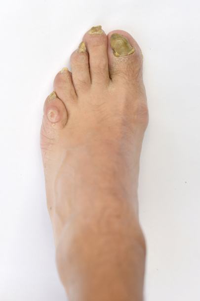 infekcji grzyba na paznokcie - Zdjęcie, obraz
