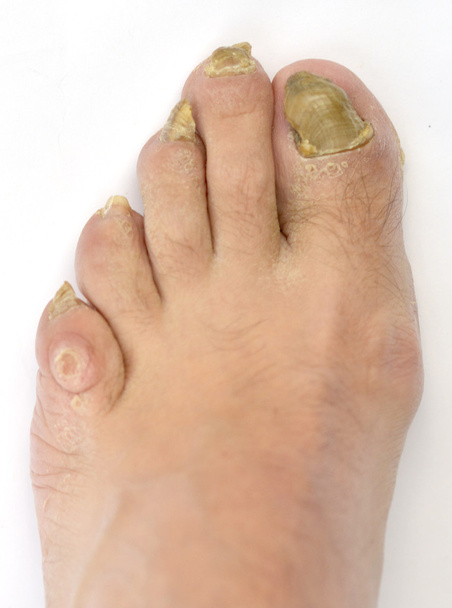 Інфекція грибка на нігтях
 - Фото, зображення