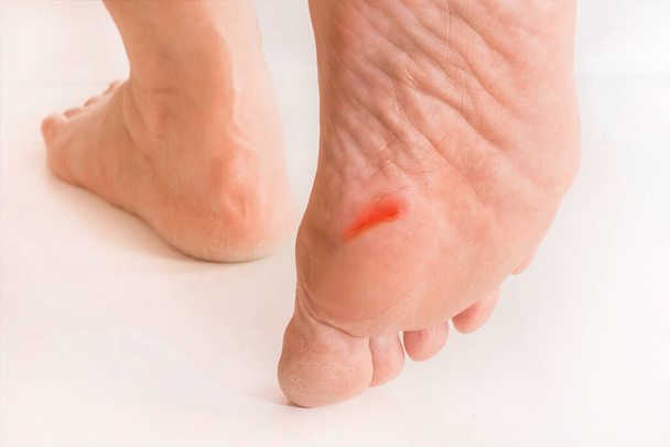 白い背景に足に傷のある高齢女性の足,クローズアップ - 写真・画像