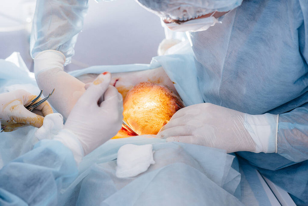 Műtét egy modern műtőben közelkép, sürgősségi mentés és újraélesztés a beteg. Gyógyszer és sebészet - Fotó, kép