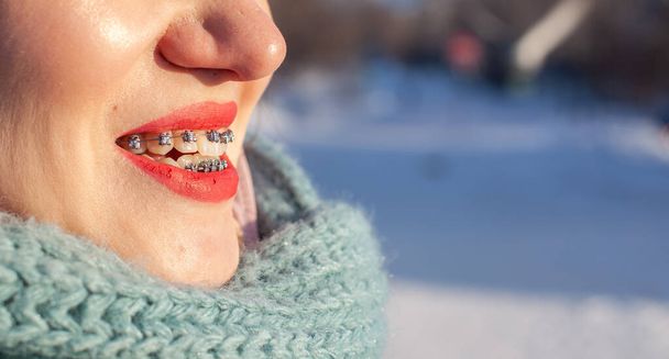 Дівчина має брекети на зубах. Дівчинка взимку на вулиці посміхається і брекети видно на зубах. Гладкі зуби з установки брекетів
 - Фото, зображення