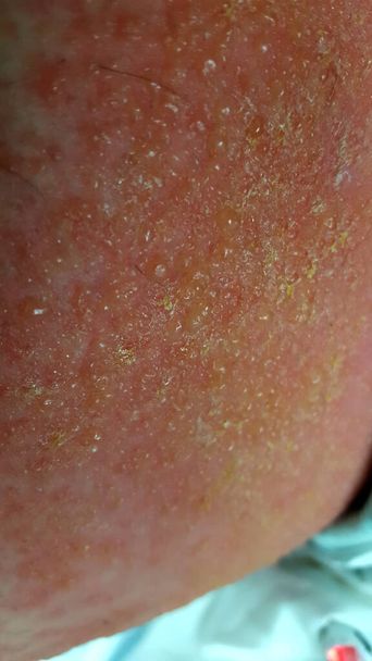 Dermatitis de contacto con celulitis estreptocócica secundaria y linfangitis - Foto, imagen