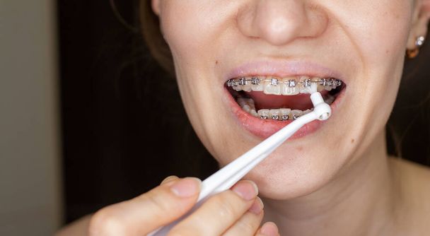 Girl with braces on her teeth brushing her teeth with a toothbrush, close-up. Dental and oral care. Braces for leveling teeth - Photo, Image