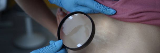 Médecin en gants de caoutchouc examinant les vergetures sur la peau des patients dos. Dermatologue tenant une loupe dans les mains - Photo, image