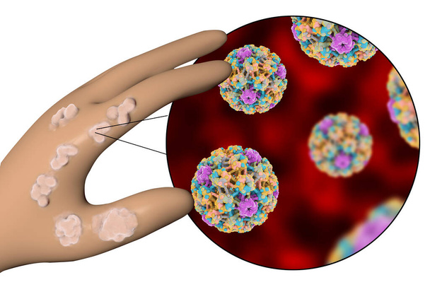 Ręka z brodawek i widok z bliska wirusa brodawczaka, który powoduje rozwój brodawek, Ilustracja 3D - Zdjęcie, obraz
