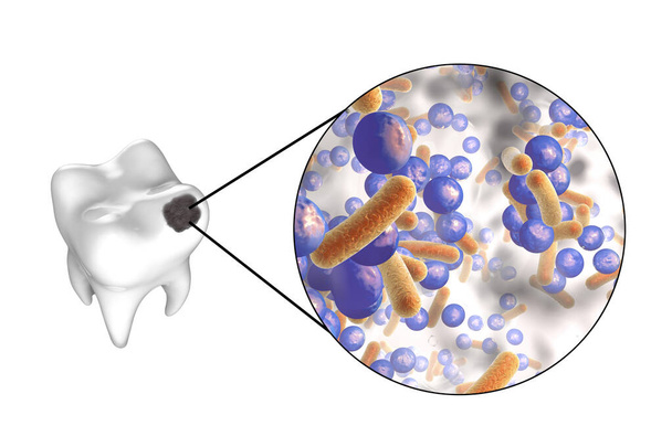 Tand met tandcariës en close-up zicht van microben die cariës veroorzaken, 3D illustratie - Foto, afbeelding