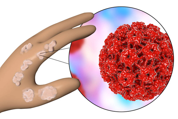 Mano con verruche e vista da vicino del papillomavirus che causa lo sviluppo di verruche, illustrazione 3D - Foto, immagini