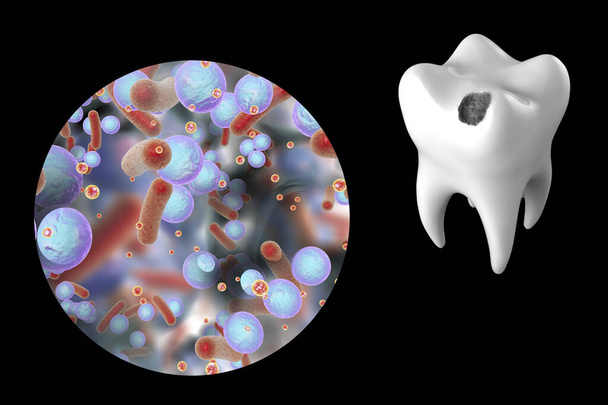 Tooth with dental caries and close-up view of microbes which cause caries, 3D illustration - Photo, Image